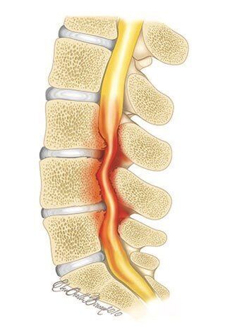With thoracic spine osteochondrosis, spinal canal compression occurs