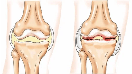 Chondromatosis