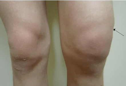 Hemarthrosis of the knee joint