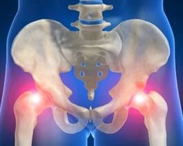 Causes of hip joint arthrosis
