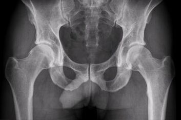 Diagnostic options for hip joint arthrosis