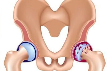 Stages of development of hip joint arthrosis