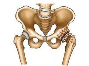 What is hip arthrose arthrosis
