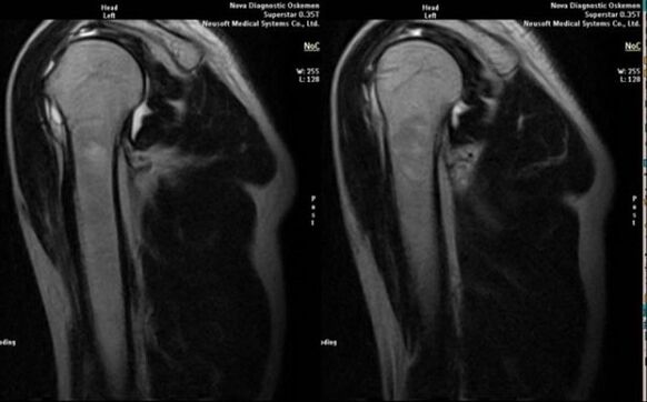 X-ray to diagnose shoulder arthrosis