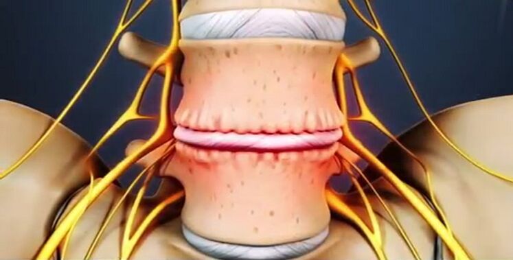 lesions of the spine due to osteochondrosis